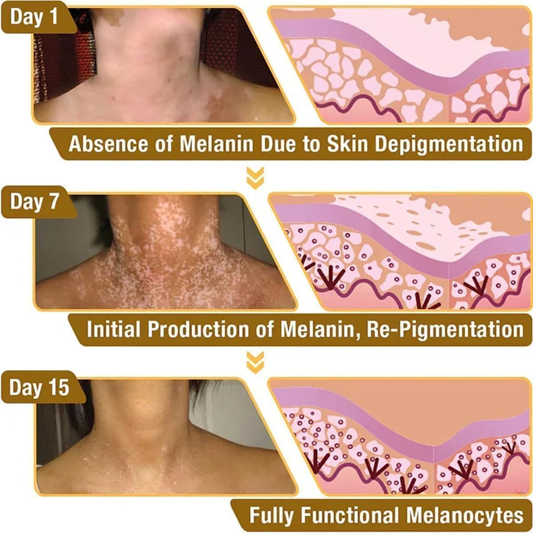 Vitiligo Bee Venom, Whitening Body Skin Care Cream